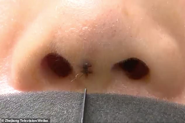 Một người phụ nữ phát hoảng khi thấy thanh silicone được cấy ghép trong mũi bỗng 