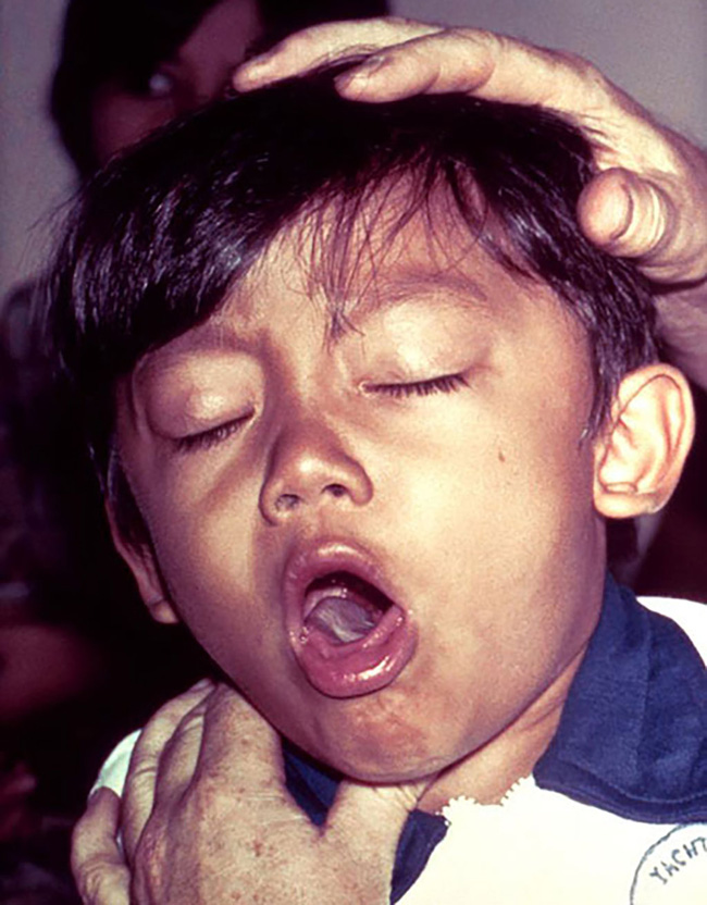 Liên tiếp xuất hiện các ổ bệnh bạch hầu tại Việt Nam: Đây là lý do bạch hầu có thể lây mạnh và vô cùng nguy hiểm cho tính mạng người bệnh - Ảnh 3.