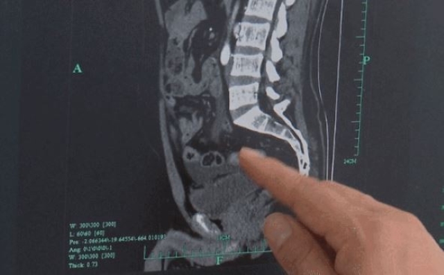 Uống 10 lon bia, người đàn ông bí tiểu kéo dài 18 tiếng, kết quả chẩn đoán thủng bàng quang - Ảnh 2. Uống 10 lon bia, người đàn ông bí tiểu kéo dài 18 tiếng, kết quả chẩn đoán thủng bàng quang - Ảnh 2.