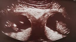 Kỳ lạ mẹ bầu mang song thai, nhưng là trong 2 tử cung khác nhau