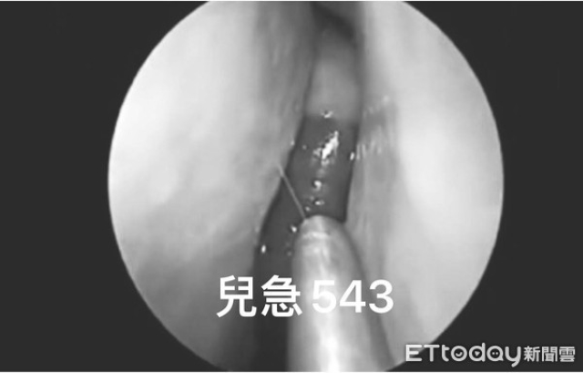 Bé trai 12 tuổi bị nghẹt mũi, chảy máu mũi suốt 1 tuần, đến bệnh viện khám bác sĩ gắp ra con đỉa dài 5cm - Ảnh 1.