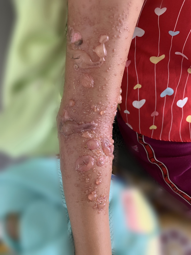 Tai nạn nguy hiểm: Tắm biển gần nhà, bé gái 8 tuổi ở Bình Thuận bị sứa 