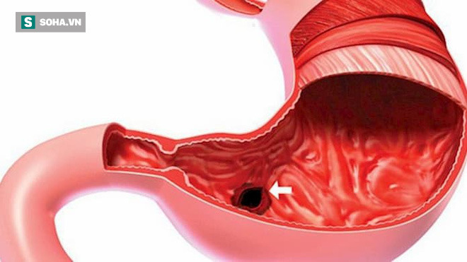 Cách ăn khoa học dành cho người có vấn đề về dạ dày: Đừng mắc sai lầm, bệnh ngày càng nặng - Ảnh 3.