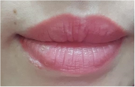 Người phụ nữ  nhiễm Herpes sau phun xăm môi với tổn thương dát đỏ vùng cẳng bàn tay 2 bên - Ảnh 1.