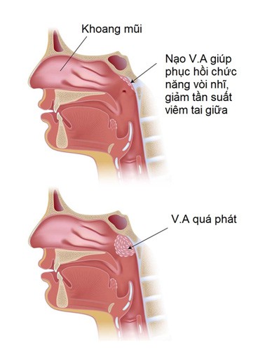 Trẻ bị viêm tai giữa, phải làm sao? - Ảnh 2.