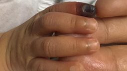 Bé 28 ngày tuổi có nguy cơ phải tháo bỏ đốt ngón tay vì mẹ đeo bao tay cả ngày không tháo ra kiểm tra
