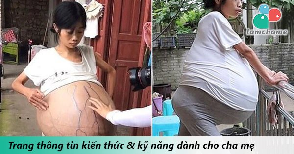 Người Phụ Nữ Có Bụng Bầu Khổng Lồ Lớn Dần Suốt 2 Năm Qua Khiến Bác Sĩ Hoang Mang Tột độ Vì 0221