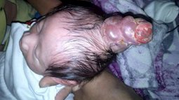 Đi khám thai đầy đủ và được thông báo thai nhi bình thường, bà mẹ choáng váng nhìn con chào đời có một "cái sừng" ở trên đầu