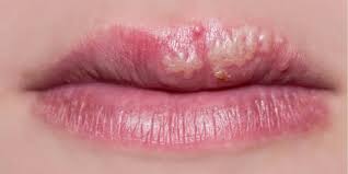 Cảnh báo nhiễm herpes khi xăm môi - Ảnh 2.