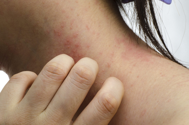 Chia sẻ của người phụ nữ vượt qua nỗi mặc cảm vì mắc bệnh eczema - Ảnh 1.
