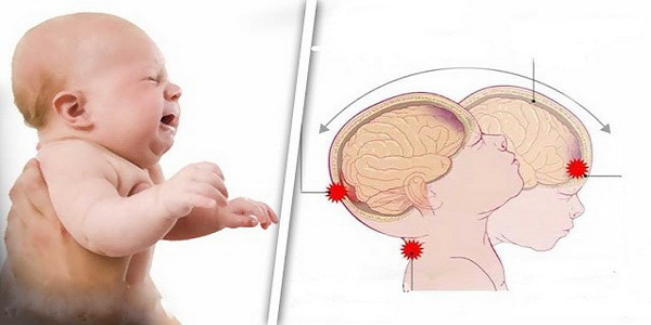 Dỗ mãi con không nín khóc, ông bố trẻ đã rung lắc thô bạo đến nỗi con trai 7 tuần tuổi bị tổn thương não vĩnh viễn - Ảnh 3.