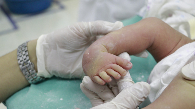 Phục hồi chức năng bàn chân khoèo bẩm sinh cho bé sơ sinh 10 ngày tuổi - Ảnh 2.