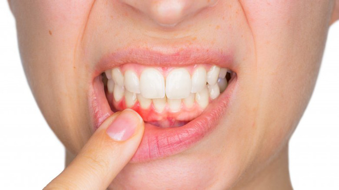Những căn bệnh từ việc không đánh răng hàng ngày - Ảnh 5.