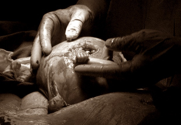 20 năm sau khoảnh khắc ấn tượng, thai nhi 21 tuần tuổi trong bức ảnh thò tay ra khỏi tử cung mẹ nắm chặt ngón tay bác sĩ giờ ra sao? - Ảnh 1.