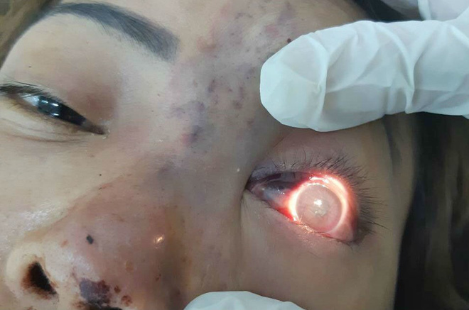 BV Việt Đức: Cấp cứu khẩn cứu đôi mắt cho bệnh nhân bị mù ngay sau khi tiêm filler tại spa - Ảnh 2.