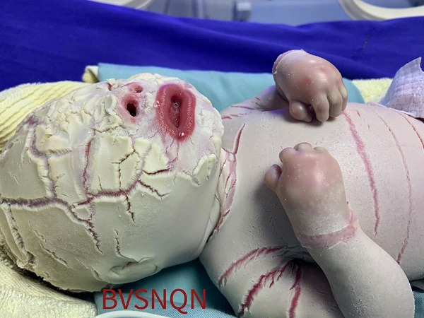 Mắc bệnh lý rối loạn da di truyền Harlequin Ichthyosis một trẻ sơ sinh bị da khô cứng toàn thân hiếm gặp - Ảnh 1.