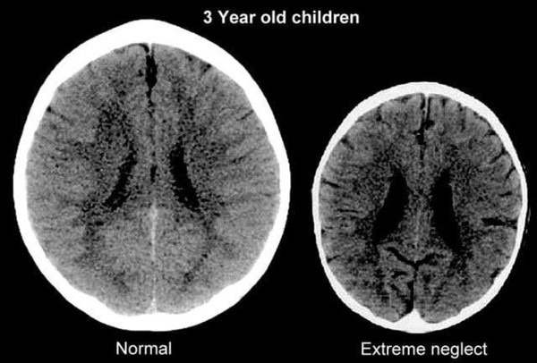 Cậu bé 3 tuổi bị teo não như cụ ông 80, vừa lật áo khám bác sĩ đã giật mình vì trông thấy điều này - Ảnh 2.