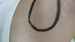 Chơi đùa với mèo rồi bị cào, bé gái 9 tuổi mắc bệnh lạ, sưng u cục ở cánh tay và nách