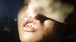 NÓNG: Điều tra nghi vấn những đứa trẻ giúp việc bị chủ quán bánh xèo ở Bắc Ninh "tra tấn" dã man, trên người có nhiều vết chém, răng bị gãy