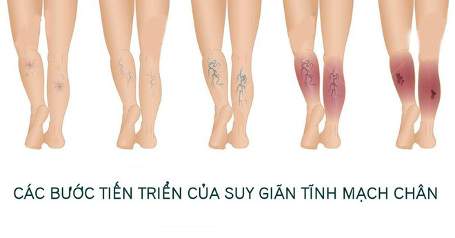 Bác sĩ BV Việt Đức: Chị em cần bỏ thói quen mặc quần quá chật - Ảnh 2.