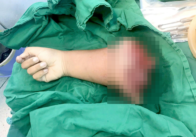 Kinh hoàng: Bé trai 8 tuổi tự chạy xe máy gặp tai nạn đứt lìa cánh tay - Ảnh 2.