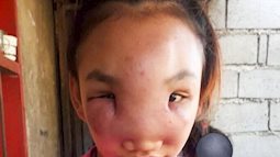 Nặn mụn trên mũi, cô gái 17 tuổi bất ngờ mắc bệnh lạ suốt 1 năm chưa khỏi