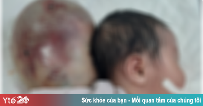 Bé sơ sinh mang khối thoát vị 