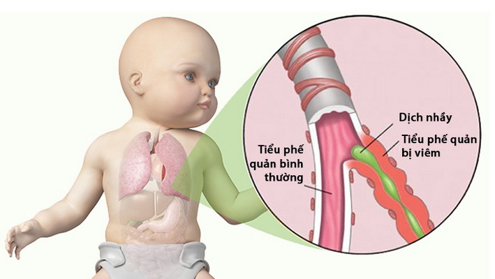 Phòng ngừa viêm tiểu phế quản ở trẻ em - Ảnh 1.