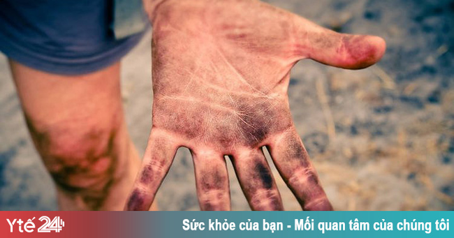 Bệnh hiếm gặp khiến con người không có dấu vân tay - Ảnh 1.