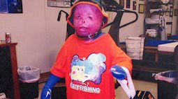 Cậu bé từng bị bỏng 95% cơ thể, trải qua 87 cuộc phẫu thuật đau đớn, bị gọi là người ngoài hành tinh bây giờ ra sao sau nhiều năm?