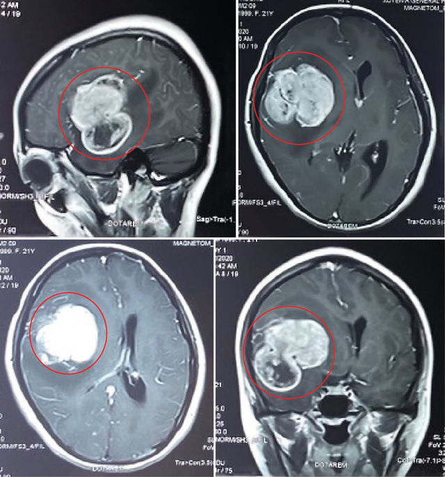 Cô gái trẻ phát hiện u não khổng lồ sau gần 1 tháng bị đau đầu - Ảnh 1.