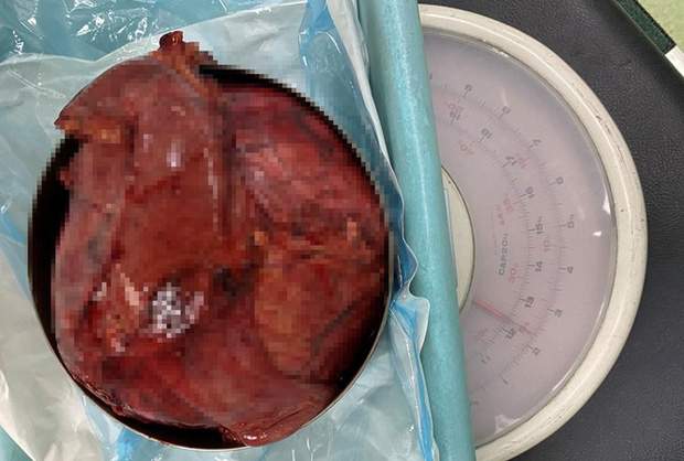 Cố nịt bụng vì sợ bị chê mập, không ngờ mang khối u tụy lớn nhất thế giới - Ảnh 1.