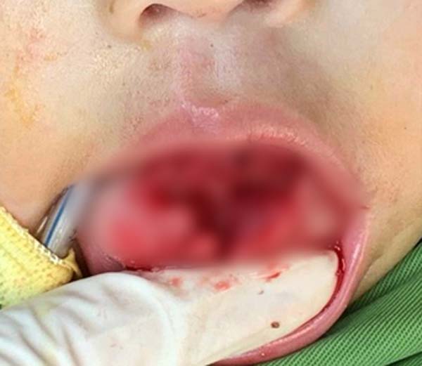 Trẻ một tuổi bị tai nạn rách lưỡi từ nguyên nhân bố mẹ nào chủ quan - Ảnh 1.