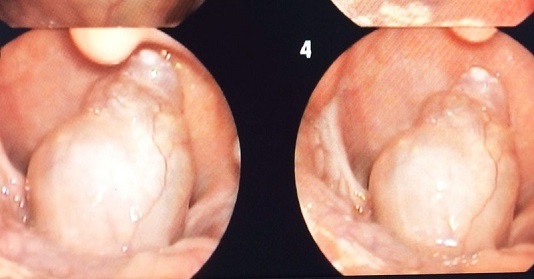 Hiếm gặp bệnh nhi 7 tuổi mắc khối u lớn vùng hạ họng - Ảnh 1.