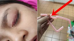 Chia sẻ bức ảnh con gái suýt mất một bên mắt vì chiếc móc áo nhựa vô hại, bà mẹ khiến hàng ngàn dân mạng run sợ, chia sẻ ầm ầm để cảnh giác