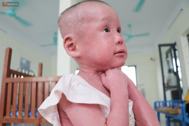 Không thể đi Singapore chữa bệnh vì dịch Covid-19, em bé da trăn bị bố mẹ bỏ rơi giờ ra sao? - Ảnh 11.