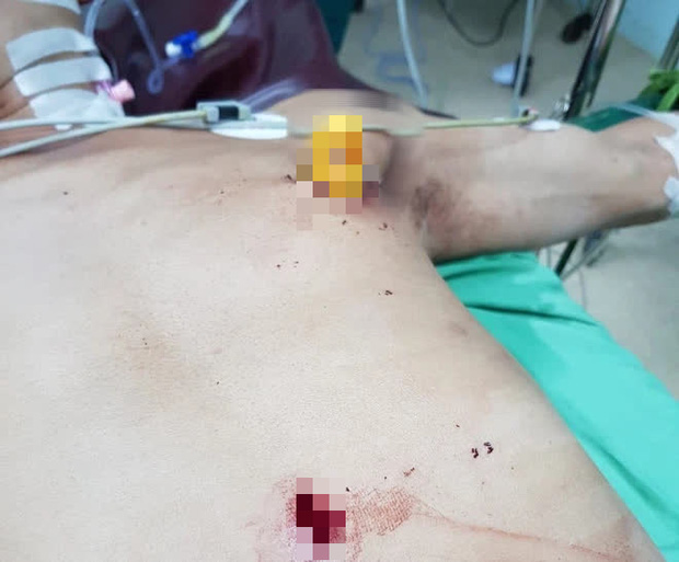 Phẫu thuật cứu sống một bệnh nhân bị dao găm vào ngực - Ảnh 1.