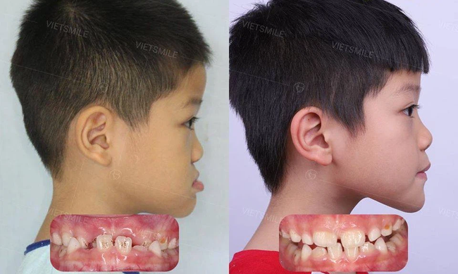 Những bệnh răng miệng ở trẻ em cần phải xử lý trước năm 12 tuổi,  nếu không sẽ ảnh hưởng đến diện mạo cả đời của trẻ - Ảnh 1.