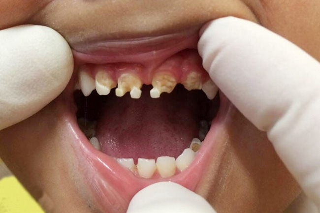 Những bệnh răng miệng ở trẻ em cần phải xử lý trước năm 12 tuổi,  nếu không sẽ ảnh hưởng đến diện mạo cả đời của trẻ - Ảnh 5.