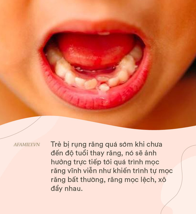 Những bệnh răng miệng ở trẻ em cần phải xử lý trước năm 12 tuổi,  nếu không sẽ ảnh hưởng đến diện mạo cả đời của trẻ - Ảnh 4.
