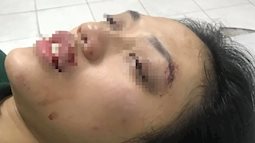 Hà Nội: Phẫn nộ người đàn ông tông nữ giáo viên ngã bất tỉnh rồi rồ ga chạy bỏ mặc nạn nhân
