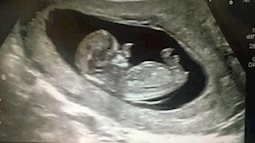 "Cậu bé Pinocchio đời thực” sinh ra với chiếc mũi to dị dạng khiến bố mẹ cũng sốc, gây bất ngờ với diện mạo sau ít năm