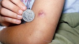 Sau 2 tháng bị sốt, ho, khó thở, người đàn ông được phát hiện mắc bệnh Whitmore