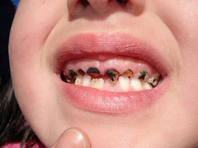 Nếu mặc kệ sâu răng và chờ rụng thay răng mới, trẻ sẽ gánh hậu quả gì? - Ảnh 23.