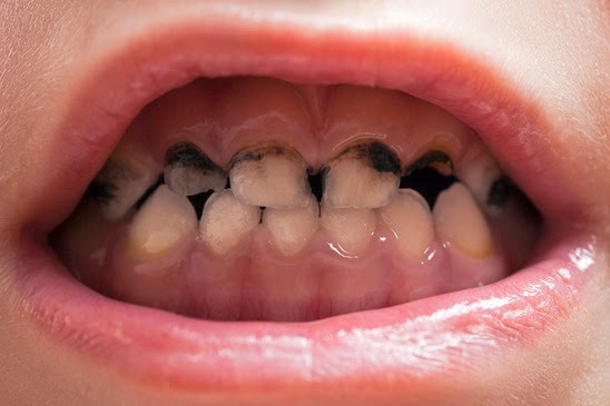 Nếu mặc kệ sâu răng và chờ rụng thay răng mới, trẻ sẽ gánh hậu quả gì? - Ảnh 21.