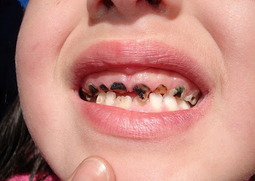 Nếu mặc kệ sâu răng và chờ rụng thay răng mới, trẻ sẽ gánh hậu quả gì? - Ảnh 17.