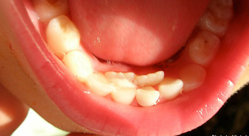 Nếu mặc kệ sâu răng và chờ rụng thay răng mới, trẻ sẽ gánh hậu quả gì? - Ảnh 8.