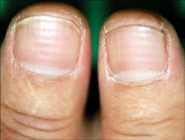4 đặc điểm xuất hiện trên móng tay là dấu hiệu cảnh báo bệnh tiểu đường - Ảnh 3.
