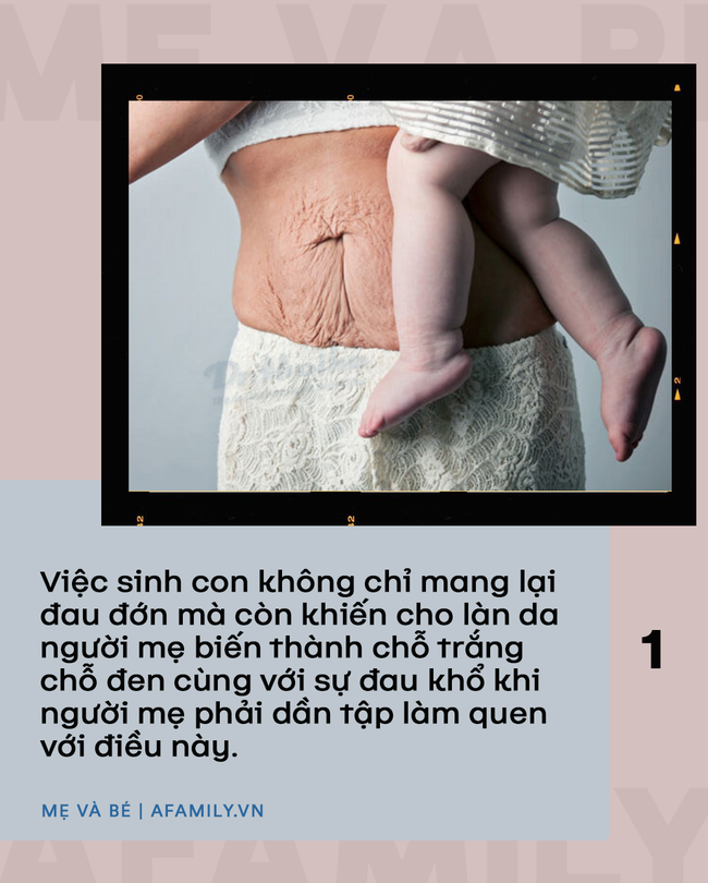 Bức ảnh chiếc bụng rạn đen sau khi sinh 10 ngày và câu chuyện sinh nở của hơn 1000 người mẹ khác khiến ai cũng phải trầm ngâm suy nghĩ - Ảnh 2.