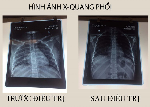 Bé 15 tuổi suýt chết vì ngộ độc do uống thuốc nam - Ảnh 1.